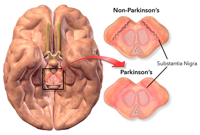 Parkinsons Protocol reviews