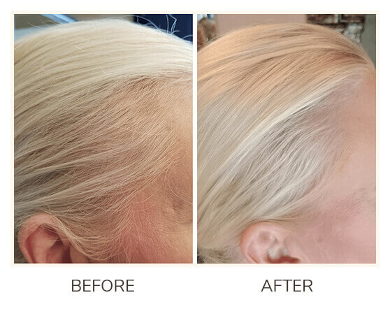 Folliboost Hair Growth Serum Before and After