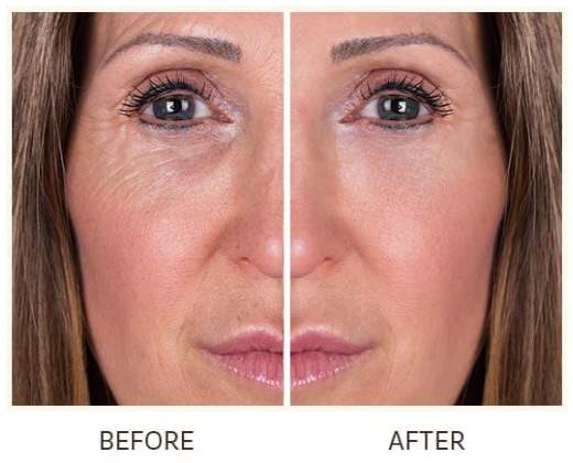  Advanced Skincare Lift Factor Plus Before and After